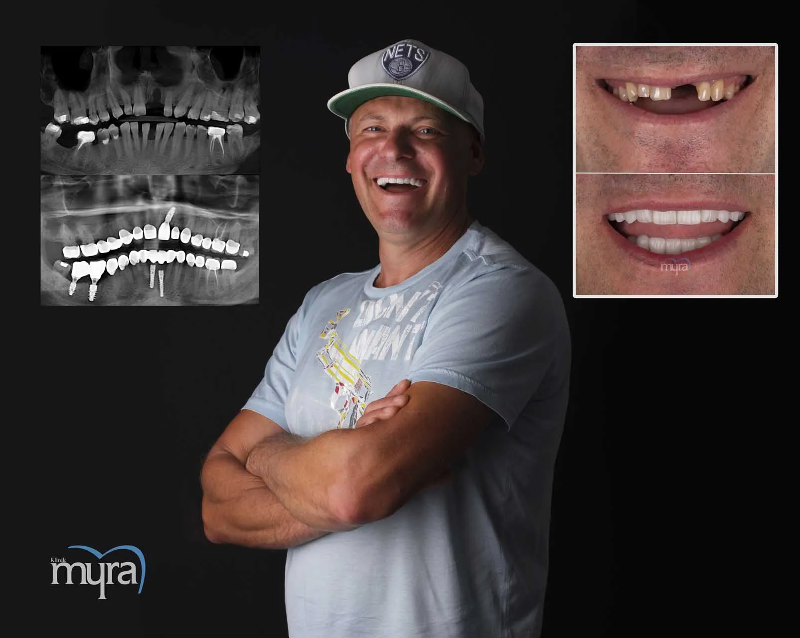 Myra Dental Centre Turkey - Dental Implants in Turkey
